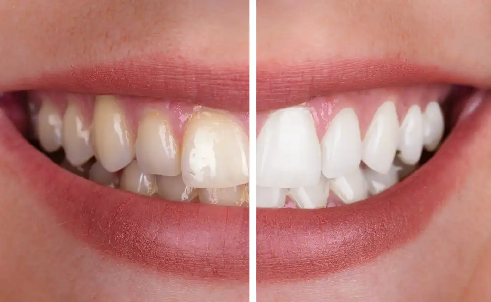 Teeth Whitening